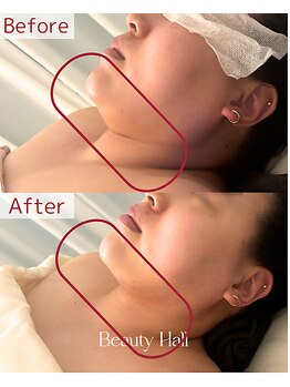 縁(en)/RED SHOT 施術効果