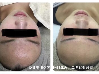 マッチ(much)/シミだけではない肌管理