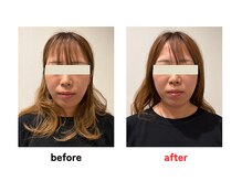 四条大宮アシスト鍼灸整骨院/美容鍼ビフォーアフター