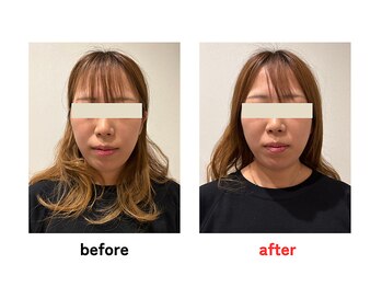 四条大宮アシスト鍼灸整骨院/美容鍼ビフォーアフター
