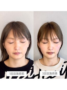 小顔矯正&美容整体サロン Still U 渋谷/3回の施術効果♪