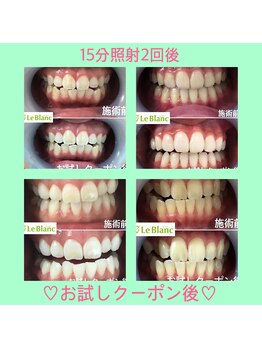 ルブラン 奈良店(Le Blanc)/ホワイトニング効果が高い