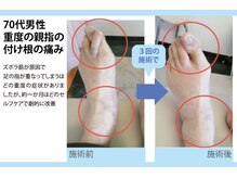 セルフケア整体 新宿店/実際のお客様◆3来店 親指付け根