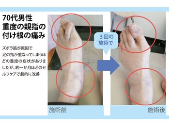 セルフケア整体 新宿店/実際のお客様◆3来店 親指付け根