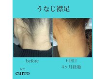 アクト クロ(ACT curro)/【うなじ襟足】脱毛施術例