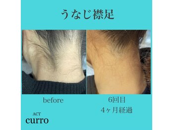 アクト クロ(ACT curro)/【うなじ襟足】脱毛施術例