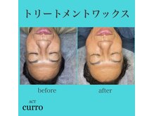 アクト クロ(ACT curro)/【フェイシャル】施術例