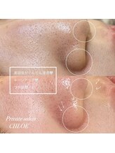 クロエ(CHLOE)/美肌フェイスワックス