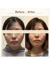アレイズ/小顔矯正コース
