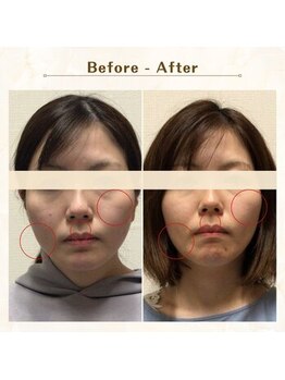 アレイズ/小顔矯正コース