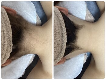 ルルトウキョウ 池袋店(LULU.tokyo)/うなじ脱毛