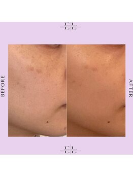 レミュ(Les mieux)/エクソリフト