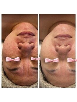 美温(mion)/おまかせフェイシャル