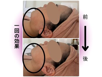 カリアンヌ/小顔/むくみ/リフトアップ/毛穴