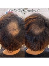 アイスブルー(Ice blue)/プロセルセラピーズBefore/After