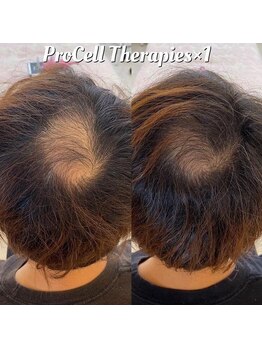 アイスブルー(Ice blue)/プロセルセラピーズBefore/After