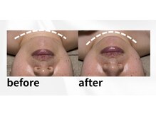 ユニ(Uni)/フェイスラインをｖライン実現