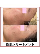 ラナン パラフューズ(Ranun's PARAFUSE.)/陶肌ビフォーアフター（4）