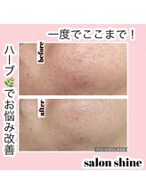 サロンシャイン(Salon Shine)/REVIハーブ３０代女性