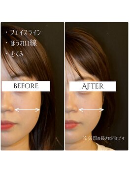 クク 赤坂 天神(99 KUKU)/【小顔】