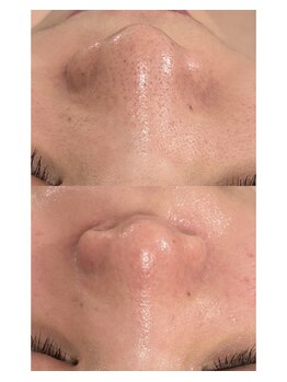 ビューティービューティー(beauty×beauty)/毛穴洗浄