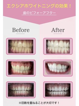 エクシアホワイトニング 日本橋店/セルフホワイトニング