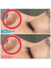 ソウ(SOU)/ハーブピーリング 1回の効果