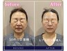 【スーパージェクション】SodiumHyaluronate＋ActiveX　導入