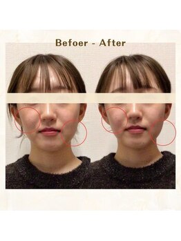 アレイズ/小顔矯正コース