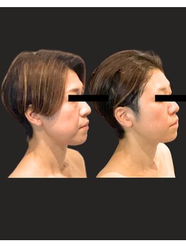 ノーブルノアール(Noble noir)/WINBACKでたるみ根本改善♪