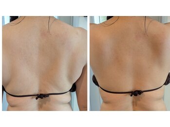 ヨサパーク アカーシャ(YOSA PARK AKASHA)/目指せ背中美人