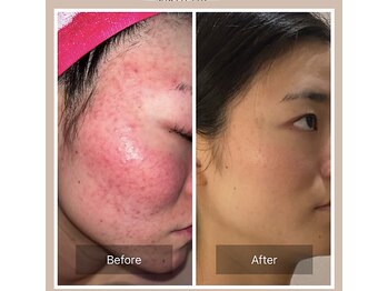 ベンザイ 梅田店(BENZAI)/繰り返す肌荒れと赤み