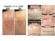 ハーブピーリング☆シミ、小じわ、くすみ、美白、ハリ、ニキビ等