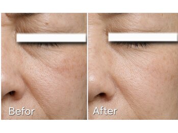 マロン(MARON)/目の下小じわ・ほうれい線改善