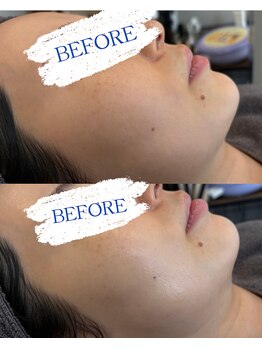 ミエラ(MIERA)の写真/セルサー施術で健やかな美肌へ！肌質別パックで輝く透明感素肌を目指そう☆