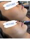 ミエラ(MIERA)の写真/セルサー施術で健やかな美肌へ！肌質別パックで輝く透明感素肌を目指そう☆