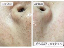 ルミア 函館店(LuMia)/黒ずみ毛穴・毛穴の大掃除はコレ