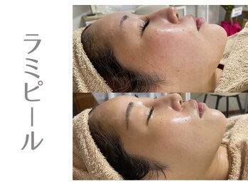 アニール(aniR)/ハーブピーリング/シミケア/毛穴