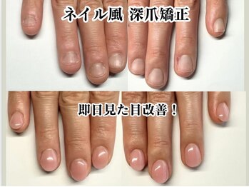 クウ(KUU)/ナチュラルカラー深爪矯正