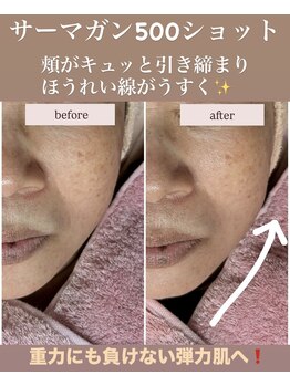 ピュルテ/重力に負けない弾力肌へ☆