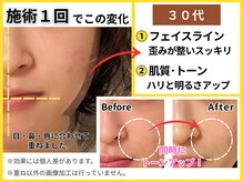 ブプラ 別府店(BUPURA)/驚きの小顔矯正！1回で変化。