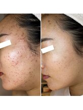 エクラムサロン 代官山(eclam salon)/施術BEFORE／AFTER