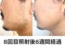 エジェリビューティー 恵比寿(egerie beauty)/髭脱毛・顎下8回照射後の施術例