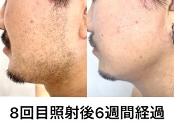 エジェリビューティー 恵比寿(egerie beauty)/髭脱毛・顎下8回照射後の施術例