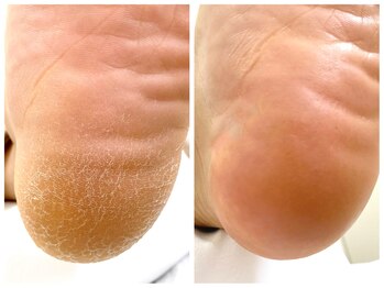 りく/角質ケア75分