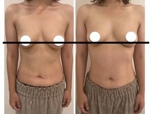 美人バスト 渋谷店/【バストアップ☆育乳】症例☆