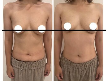 美人バスト 渋谷店/【バストアップ☆育乳】症例☆