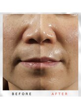 ホワイトアクア 福岡天神店(WHITE AQUA)/韓国の女医が開発したララピール