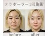 お顔の表情筋トレーニングで小顔が実現/¥19800→8800