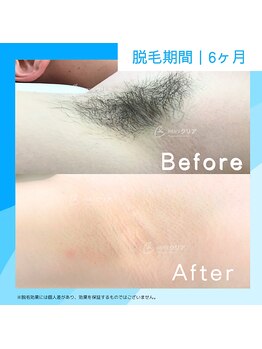 メンズクリア 広島店/【メンズクリア】お客様の施術例